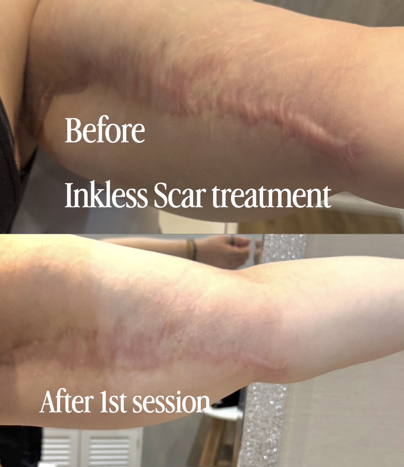 Arm Lift Surgical Scar Revision
